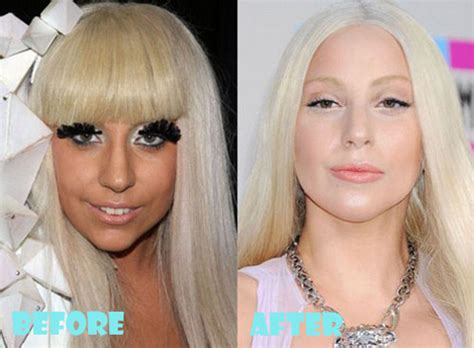 lady gaga surgery|Lady Gagas changing face: How Oscar winner retains her。